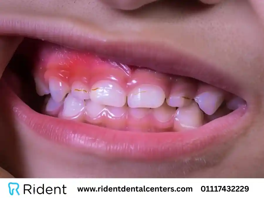 اعراض التهاب اللثة عند الاطفال